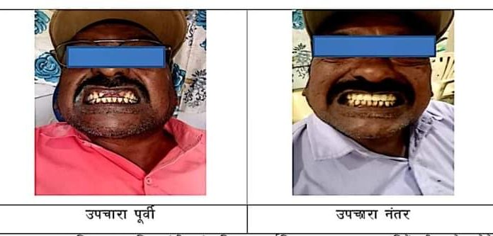 जिल्हा सामान्य रुग्णालयात आता दातांवर उत्कृष्ट उपचार